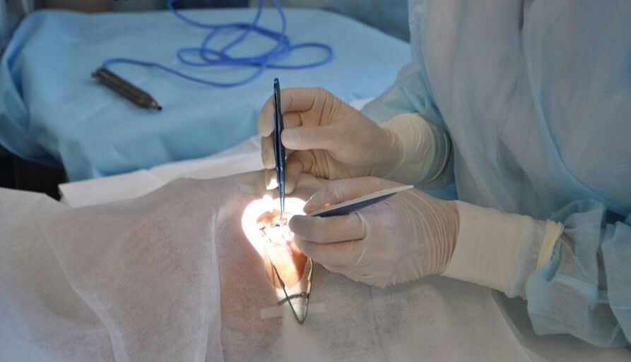 Chirurgie oculaire pour restaurer la vision
