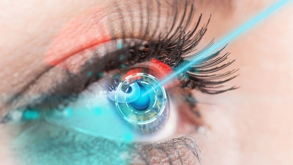 Restauration de la vision par correction laser